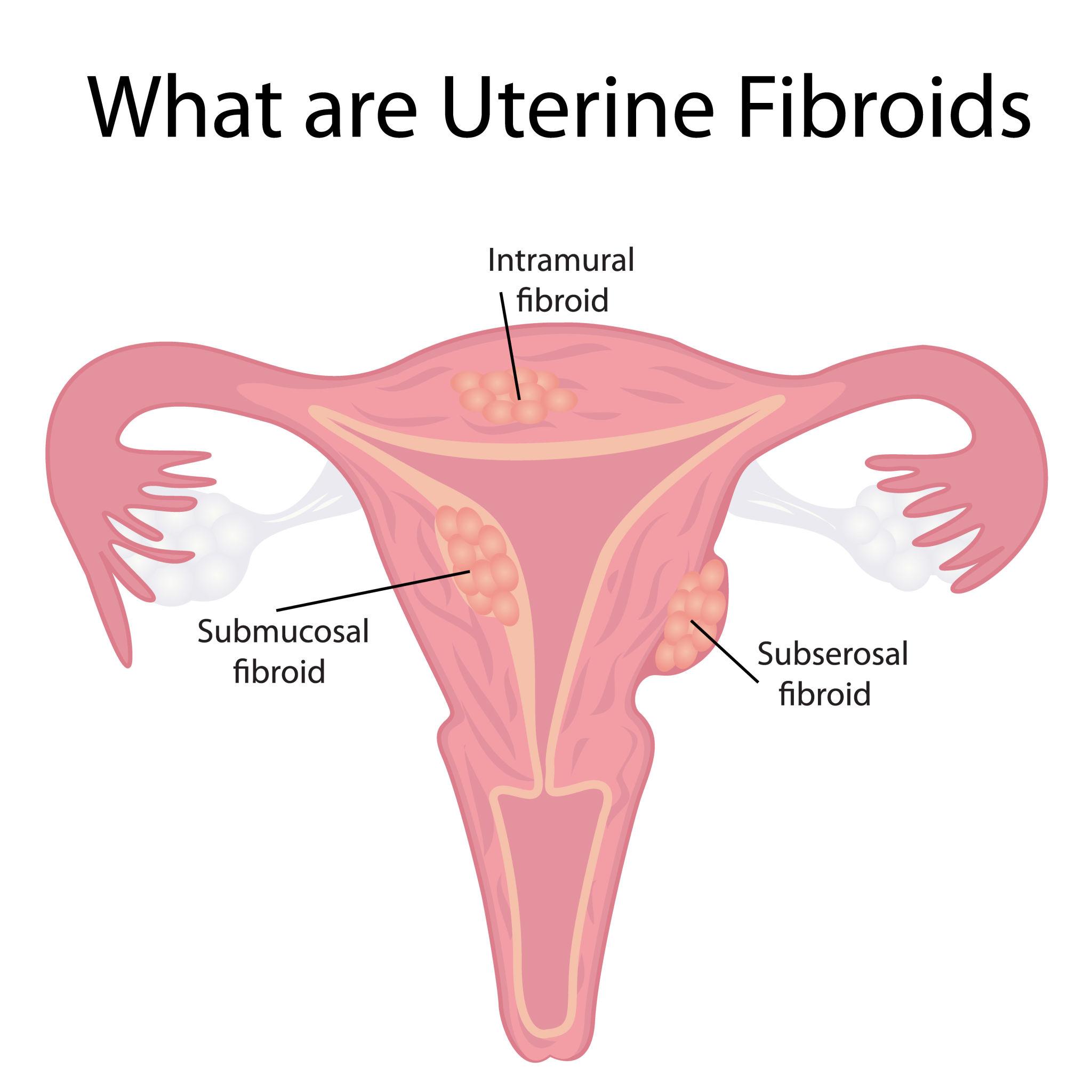 Fibroid Removal Laparoscopic Surgeon in Pune – Safe & Advanced Treatment